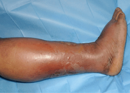 Infectious Diseases of the Limbs