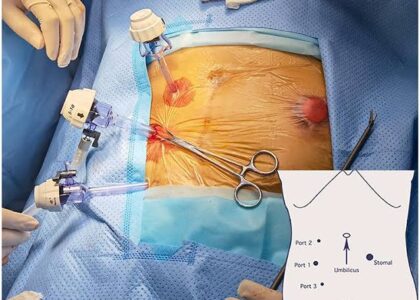 Laparoscopic Hernia Repair Workshop